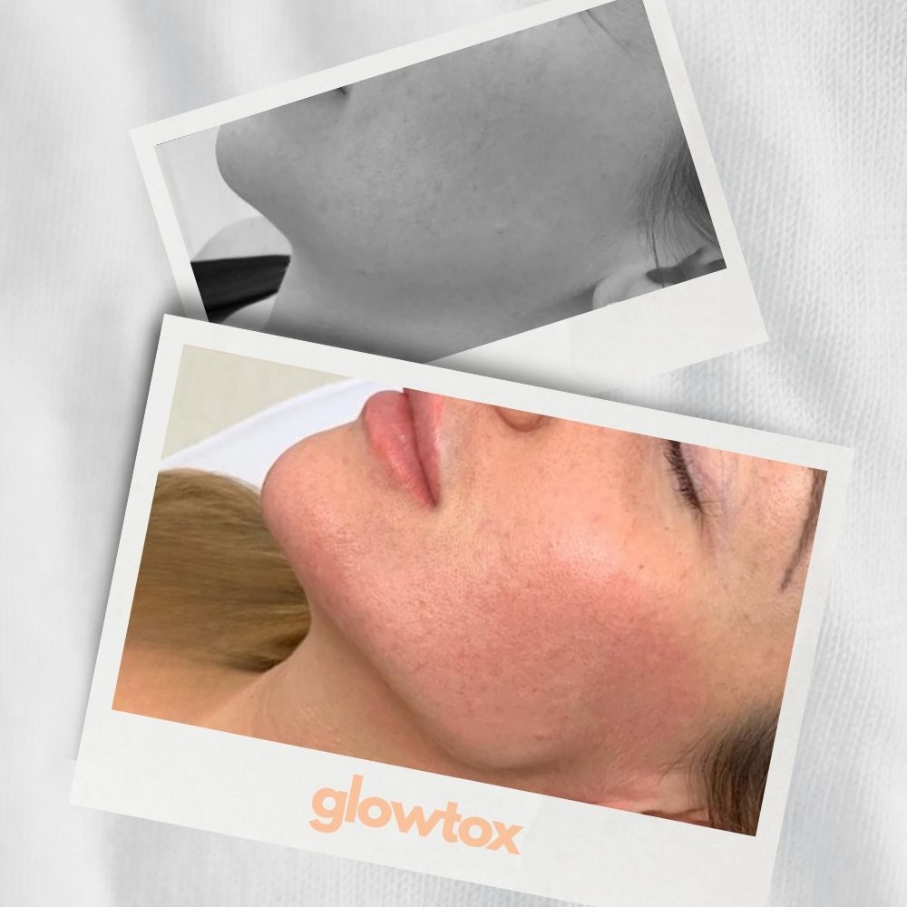 Ergebnis Foto Jawline junge Frau glowtox