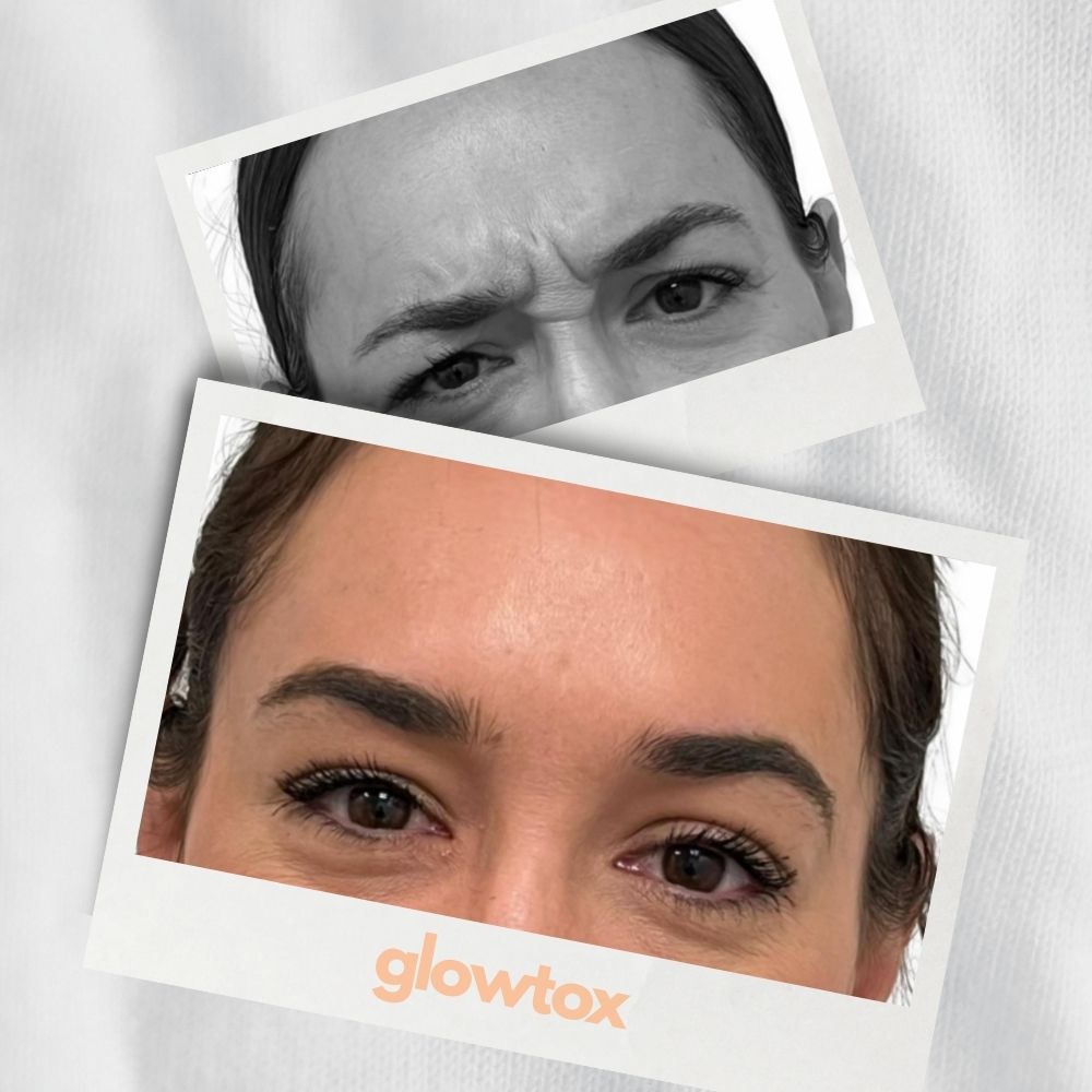 Ergebnis Foto Zornesfalte braunhaarige Frau glowtox