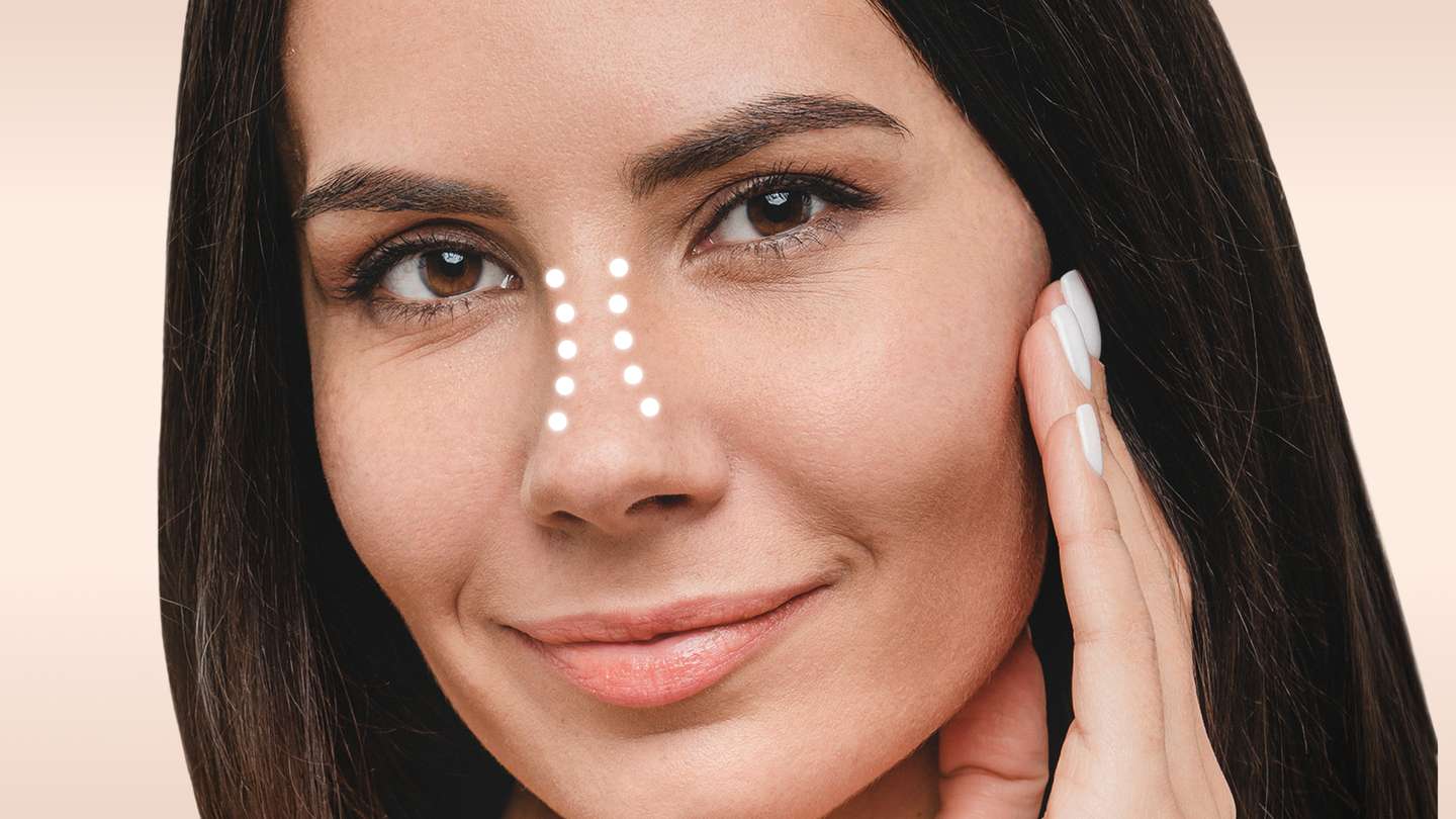 Bild Nasenverschmälerung Behandlung glowtox